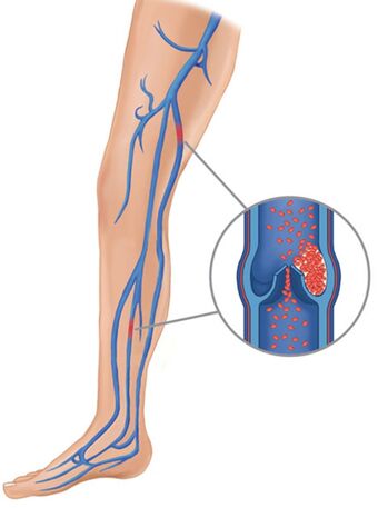 Causes of varicose veins (1)