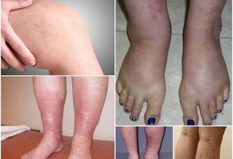 Photos of Chinese veins events on the feet