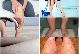 Symptoms of varicose veins on the feet