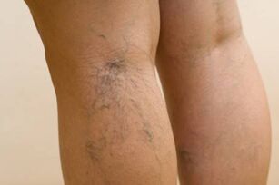 clear varicose veins signs