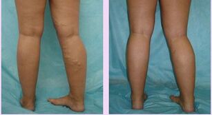 how the varicose veins of the first stage manifest