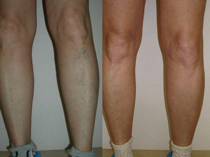 feet before and after laser treatment of varicose veins