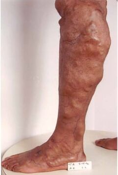 Manifestations of chronic venous insufficiency in the lower extremity