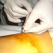 Miniflectomy is the most aesthetic treatment for varicose veins