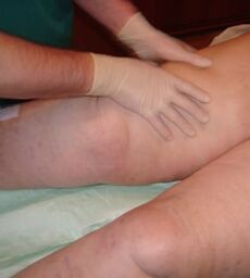 Therapeutic massage of lower limbs with varicose veins
