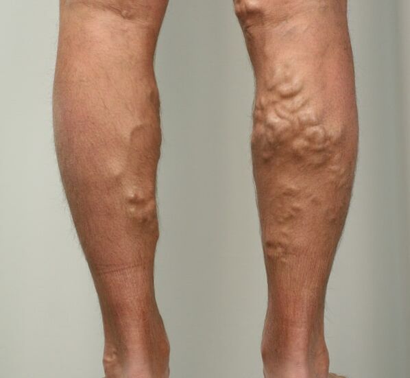 Varicose veins on the legs