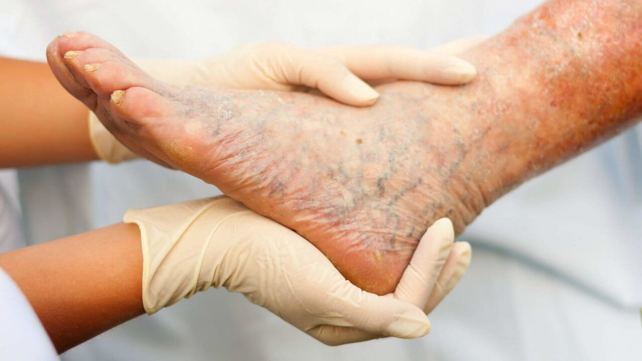 The venologist deals with the treatment of varicose veins in the legs