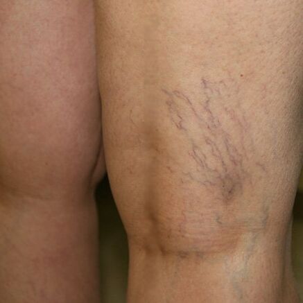 The venous plexus in the lower extremities is a sign of varicose veins
