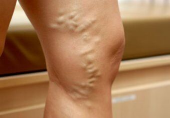 Various veins on a woman's legs
