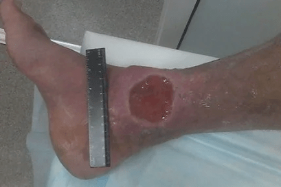 Complications of veins
