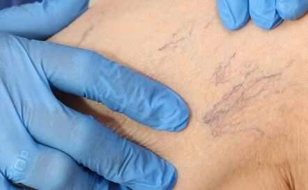 Varicose veins