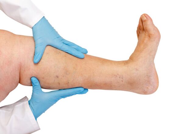 Varicose veins on the feet