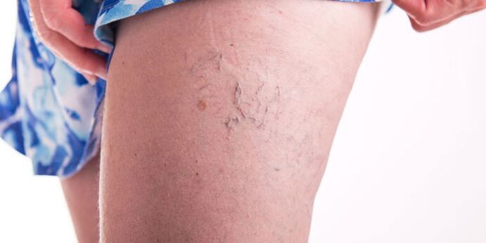 Prevention of Chinese veins