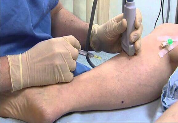 Treatment of veins of varicose veins