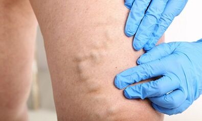 Varicose veins on the feet