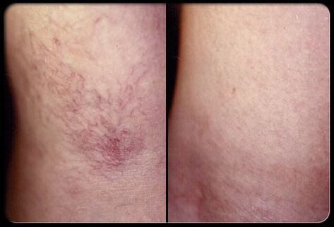 Before and after sclerotherapy