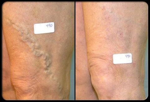 Before and after surgery in the veins
