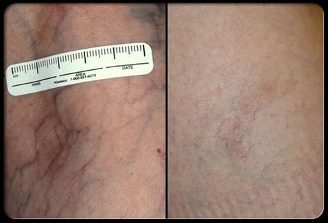 Before and after the laser treatment process