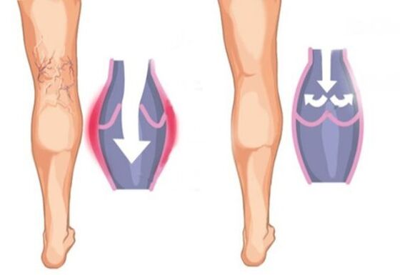 How varicose veins look like
