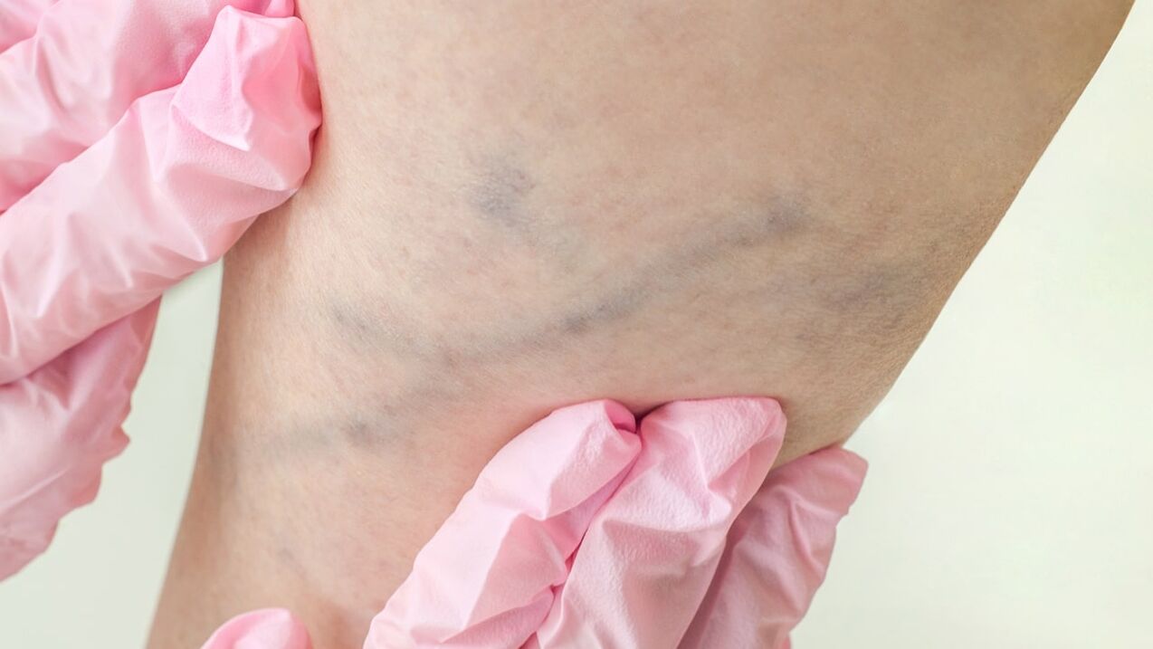 Varicose veins of the lower extremities